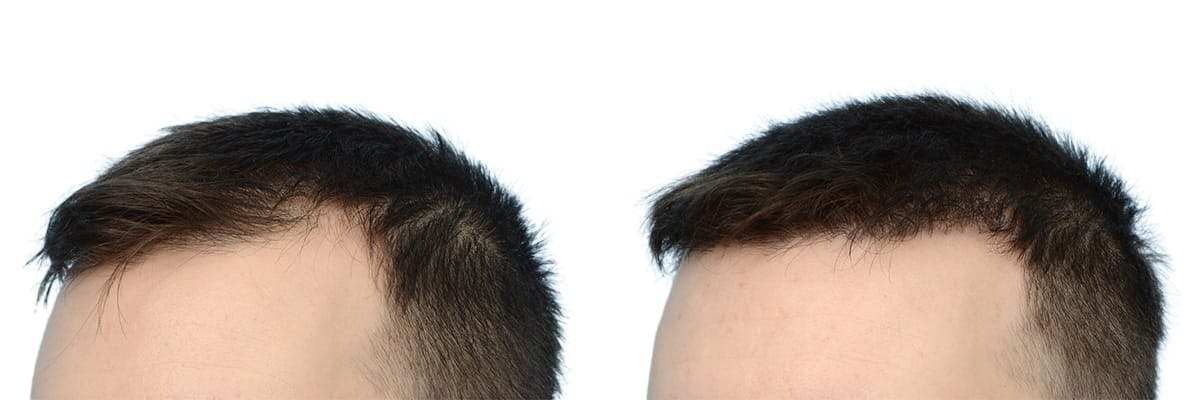 FUE Hair Transplant Before & After Gallery - Patient 172625 - Image 3