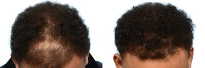 FUE Hair Transplant Before & After Gallery - Patient 413766 - Image 1
