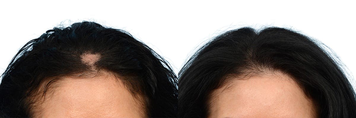 Hair Restoration Before & After Gallery - Patient 184604 - Image 1