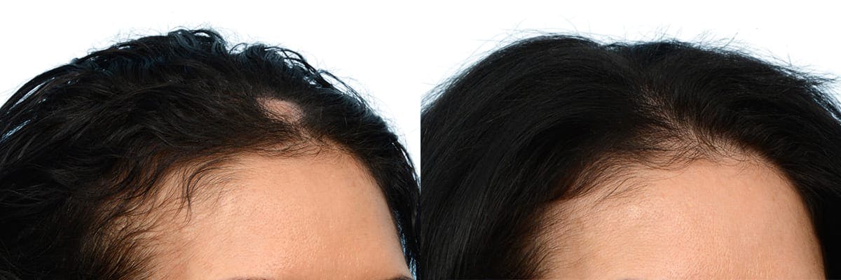Female Hair Restoration Before & After Gallery - Patient 232672 - Image 2