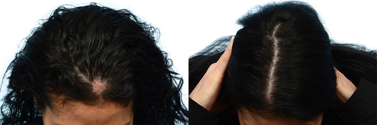 Female Hair Restoration Before & After Gallery - Patient 232672 - Image 3