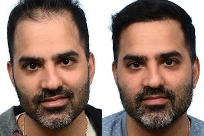 FUE Hair Transplant Before & After Gallery - Patient 284689 - Image 1