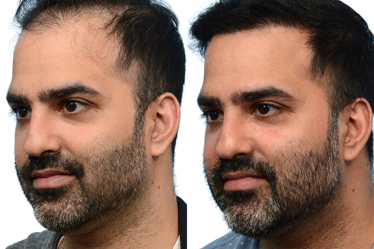 FUE Hair Transplant Before & After Gallery - Patient 284689 - Image 3