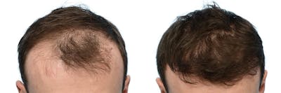 FUE Hair Transplant Before & After Gallery - Patient 360577 - Image 1