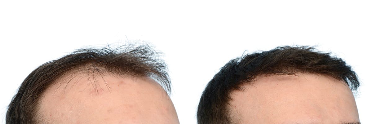 FUE Hair Transplant Before & After Gallery - Patient 360577 - Image 2