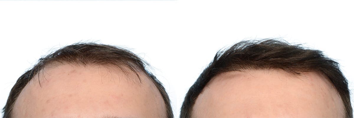 FUE Hair Transplant Before & After Gallery - Patient 360577 - Image 3