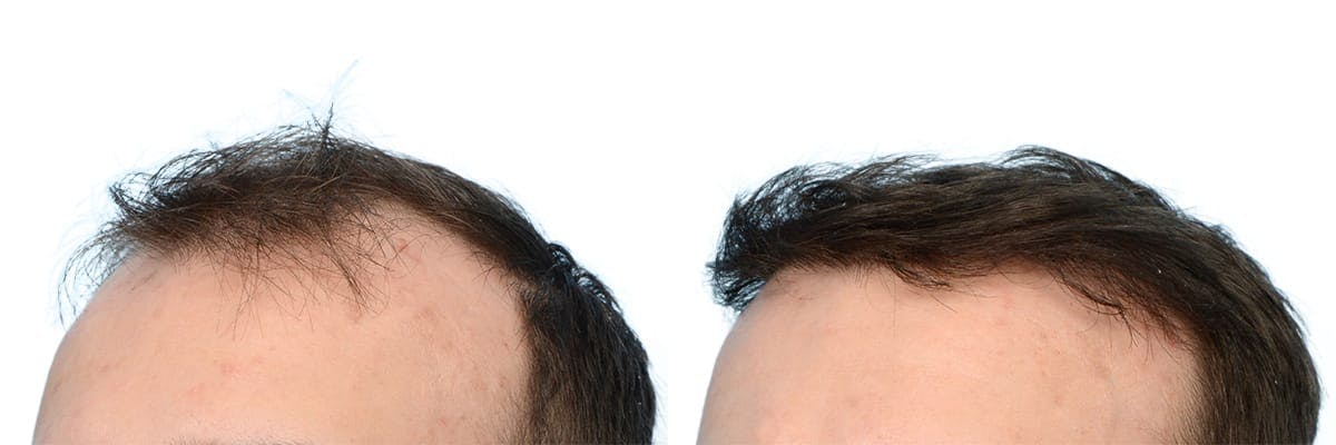 Hair Restoration Before & After Gallery - Patient 181754 - Image 4