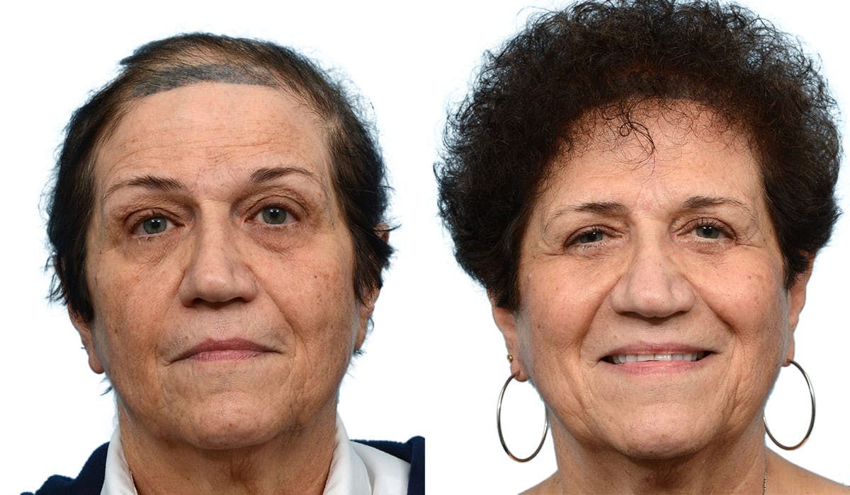Female Hair Restoration Before & After Gallery - Patient 801608 - Image 2