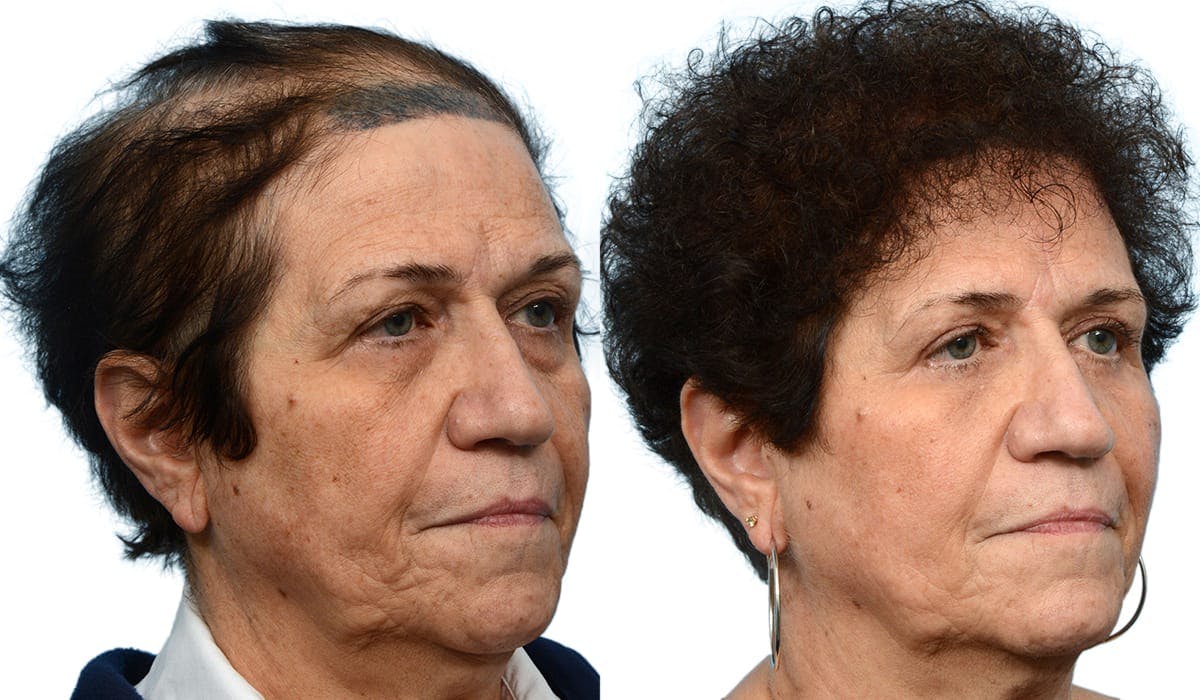 FUT Hair Transplant Before & After Gallery - Patient 404979 - Image 3