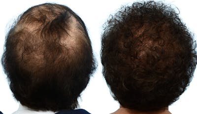 Female Hair Restoration Before & After Gallery - Patient 801608 - Image 1