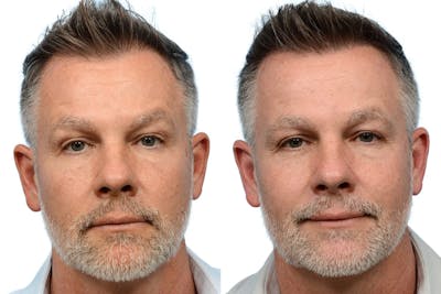 FUE Hair Transplant Before & After Gallery - Patient 292531 - Image 1