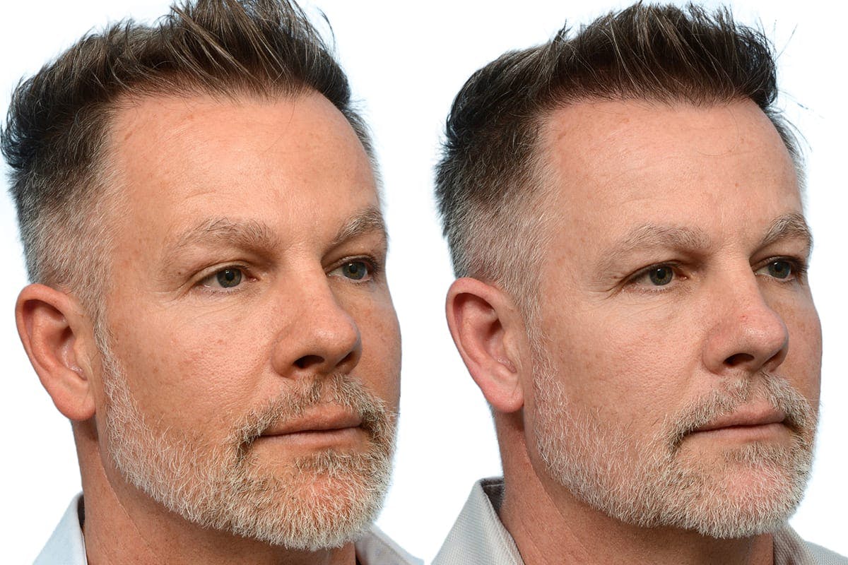 Hair Restoration Before & After Gallery - Patient 281433 - Image 2