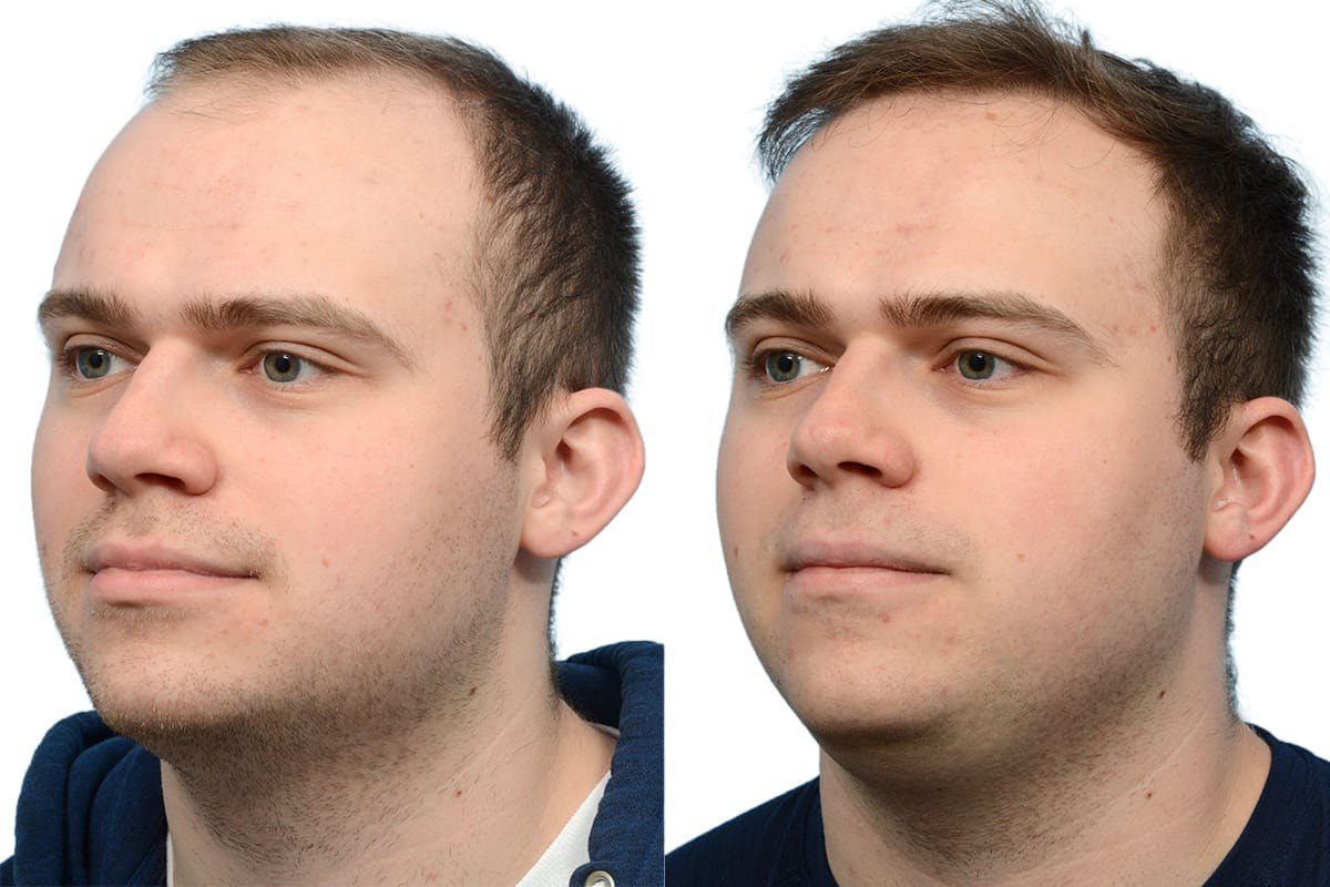 Hair Restoration Before & After Gallery - Patient 358990 - Image 3