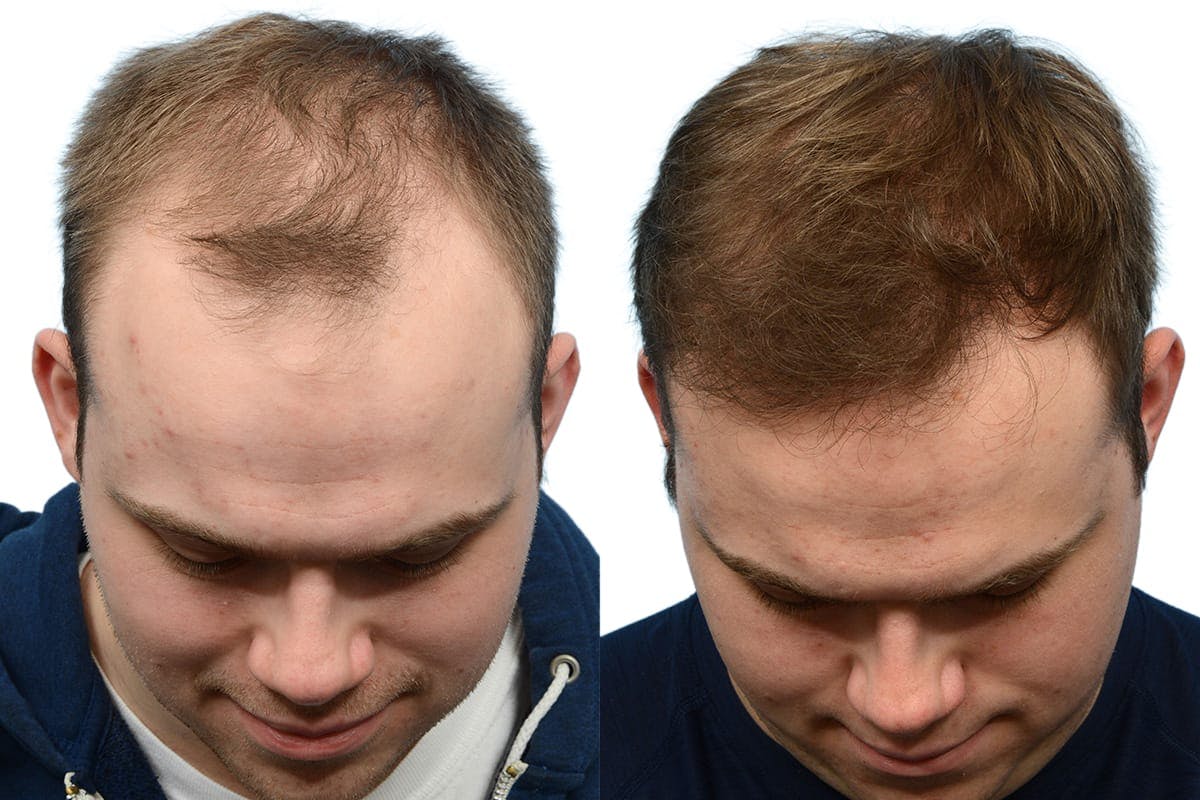 FUE Hair Transplant Before & After Gallery - Patient 650953 - Image 4