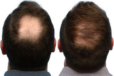 Hair Restoration Before & After Gallery - Patient 400802 - Image 1