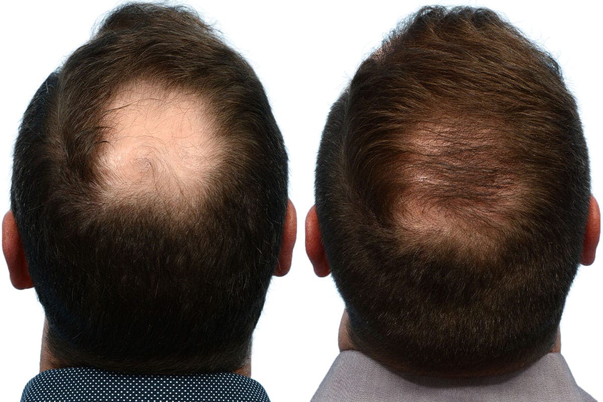 FUE Hair Transplant Before & After Gallery - Patient 182777 - Image 1