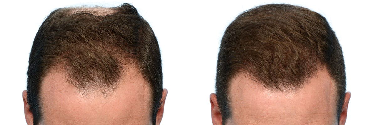 Hair Restoration Before & After Gallery - Patient 400802 - Image 2