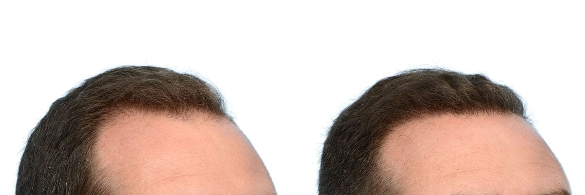 Hair Restoration Before & After Gallery - Patient 400802 - Image 3