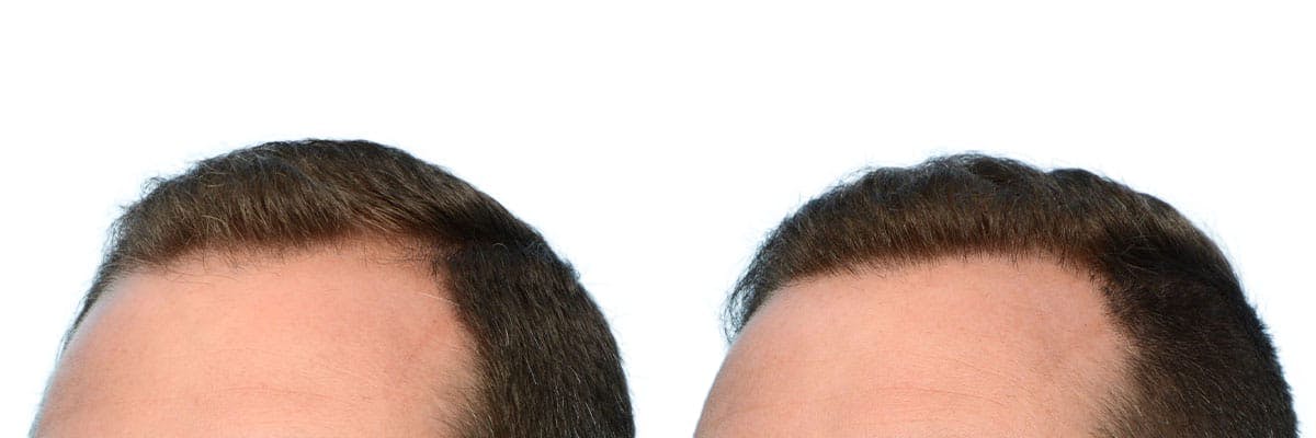 Hair Restoration Before & After Gallery - Patient 400802 - Image 4