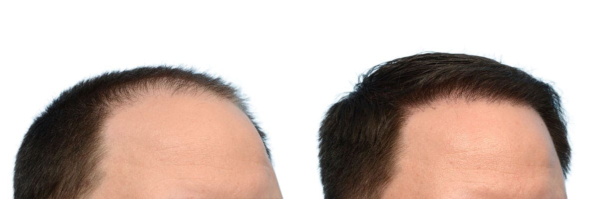 Hair Restoration Before & After Gallery - Patient 350398 - Image 2