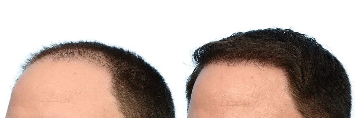 Hair Restoration Before & After Gallery - Patient 350398 - Image 3