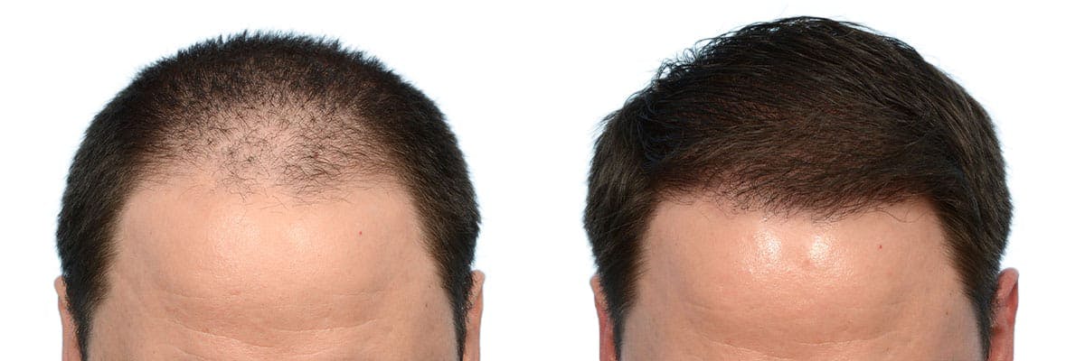 Hair Restoration Before & After Gallery - Patient 350398 - Image 1