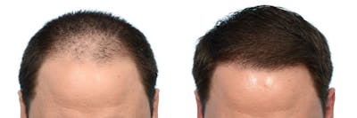 FUE Hair Transplant Before & After Gallery - Patient 156586 - Image 1