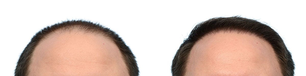 Hair Restoration Before & After Gallery - Patient 350398 - Image 4