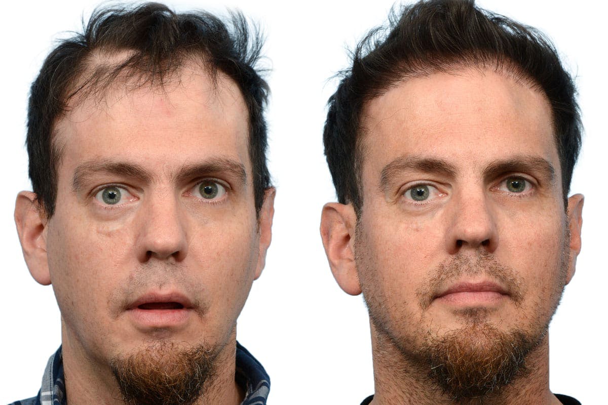 Hair Restoration Before & After Gallery - Patient 110102 - Image 2