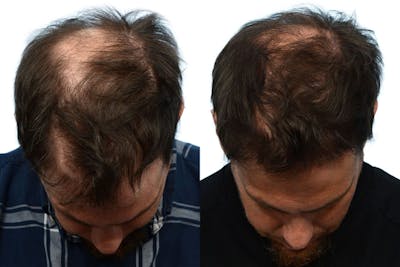 Hair Restoration Before & After Gallery - Patient 110102 - Image 1