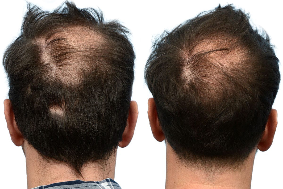 Hair Restoration Before & After Gallery - Patient 110102 - Image 3