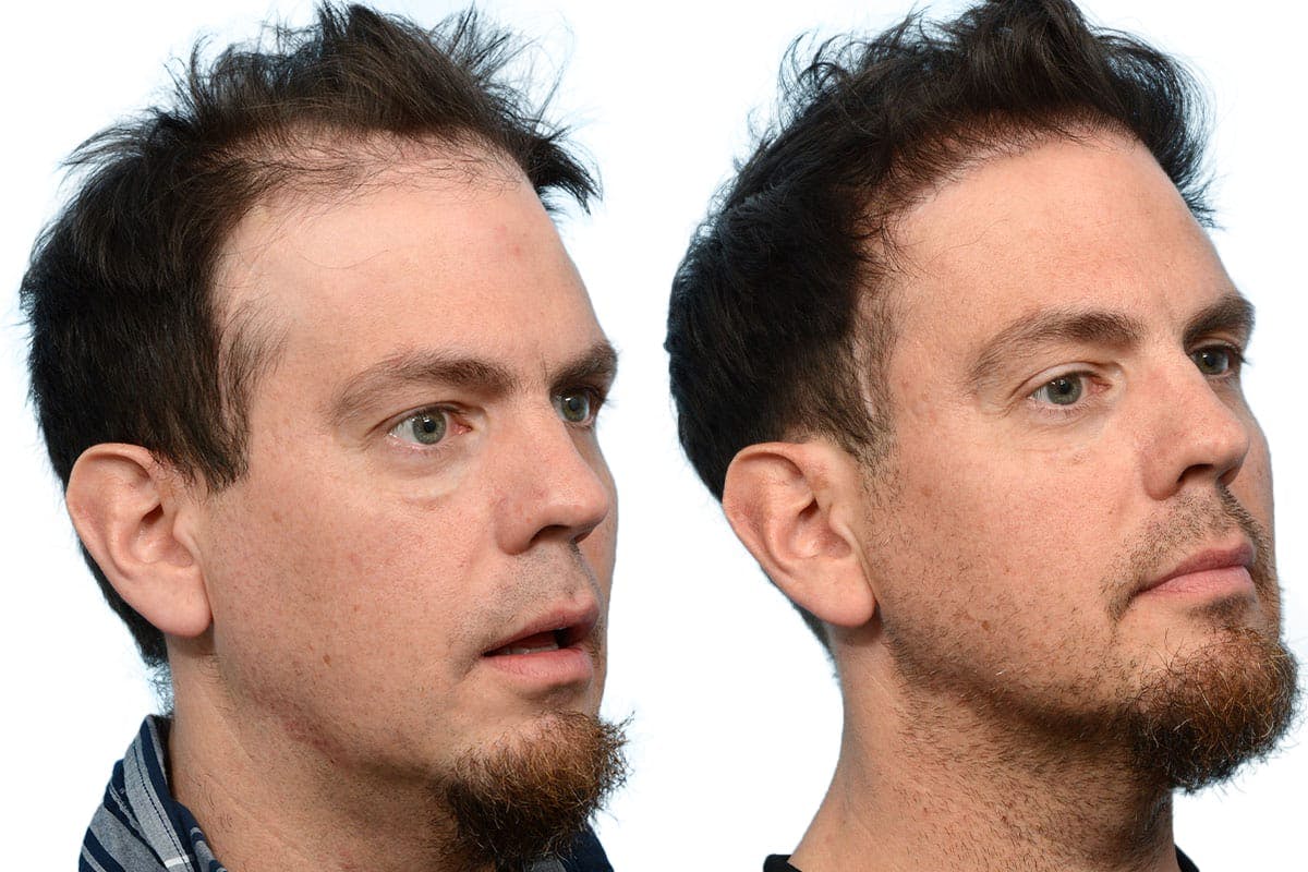 Hair Restoration Before & After Gallery - Patient 110102 - Image 4