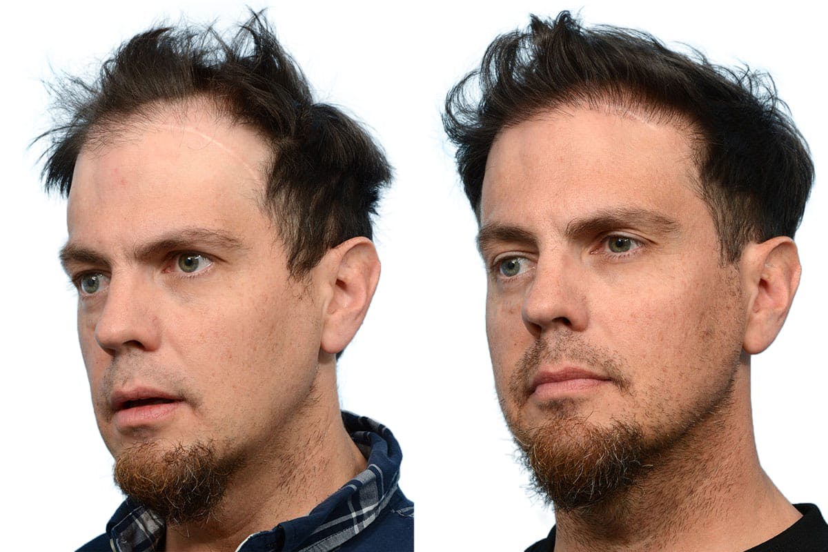 Hair Restoration Before & After Gallery - Patient 110102 - Image 5
