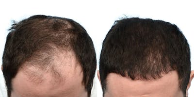 FUE Hair Transplant Before & After Gallery - Patient 786198 - Image 1