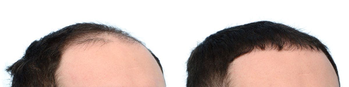 Hair Restoration Before & After Gallery - Patient 175057 - Image 2