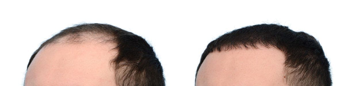 Hair Restoration Before & After Gallery - Patient 175057 - Image 3
