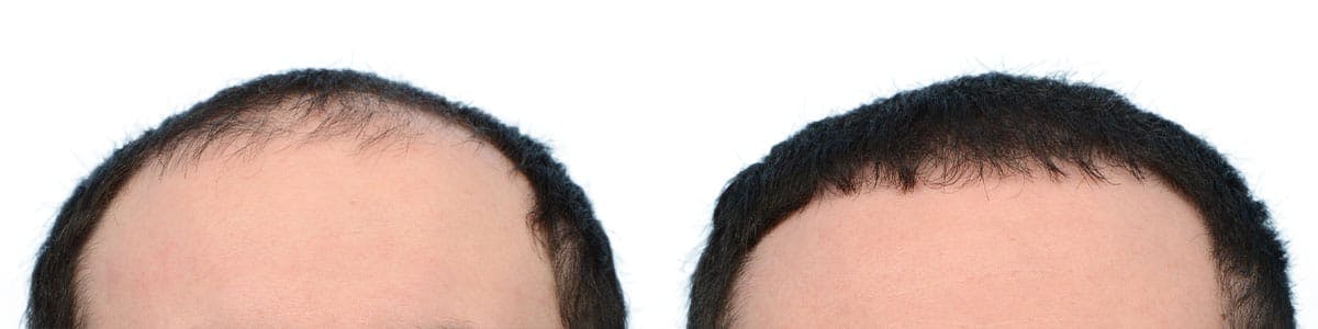 Hair Restoration Before & After Gallery - Patient 175057 - Image 4