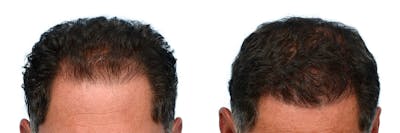 Hair Restoration Before & After Gallery - Patient 371993 - Image 1