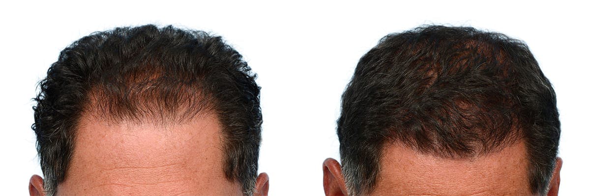 Hair Restoration Before & After Gallery - Patient 371993 - Image 1