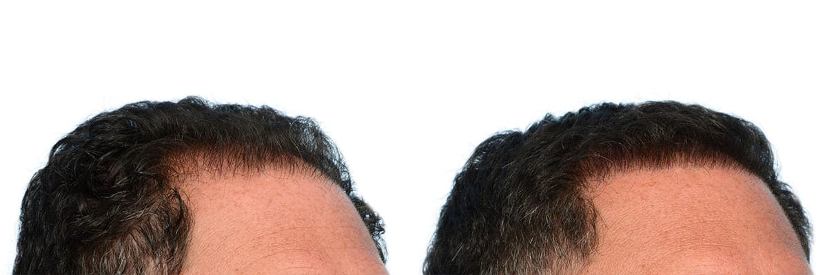 Hair Restoration Before & After Gallery - Patient 371993 - Image 2