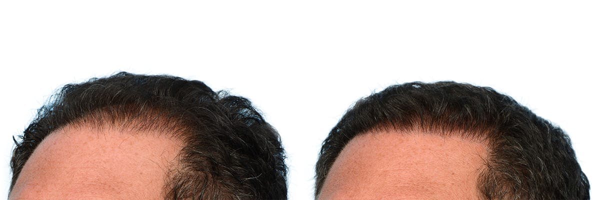 Hair Restoration Before & After Gallery - Patient 371993 - Image 3