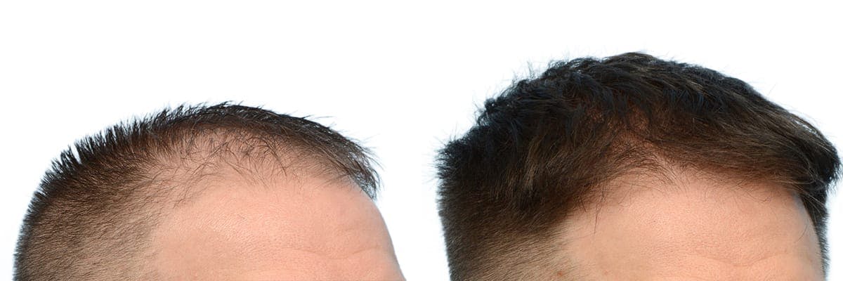 FUE Hair Transplant Before & After Gallery - Patient 308136 - Image 2