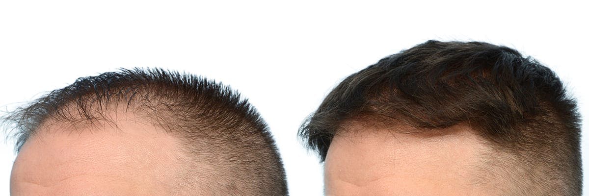 FUE Hair Transplant Before & After Gallery - Patient 308136 - Image 3