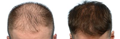Hair Restoration Before & After Gallery - Patient 168334 - Image 1