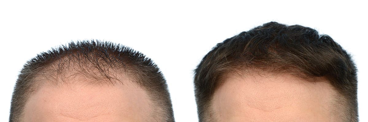 Hair Restoration Before & After Gallery - Patient 168334 - Image 4