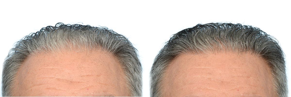 FUE Hair Transplant Before & After Gallery - Patient 865904 - Image 3