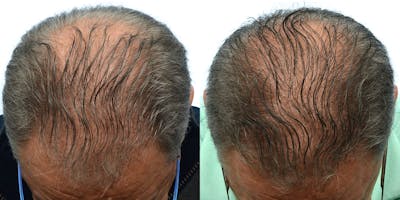 Hair Restoration Before & After Gallery - Patient 362739 - Image 1