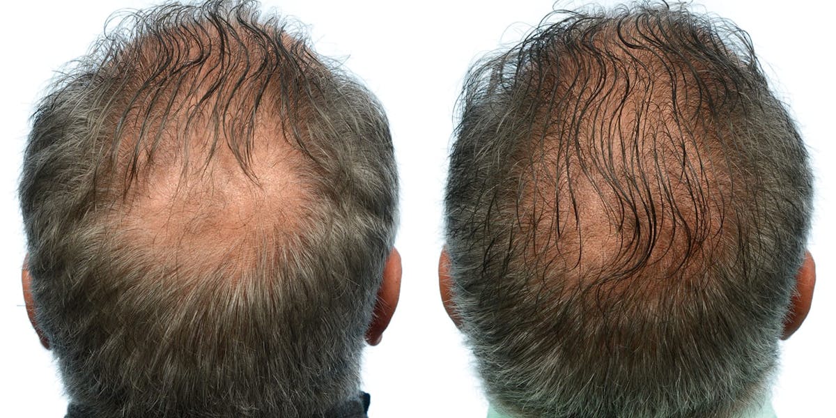 FUE Hair Transplant Before & After Gallery - Patient 865904 - Image 2