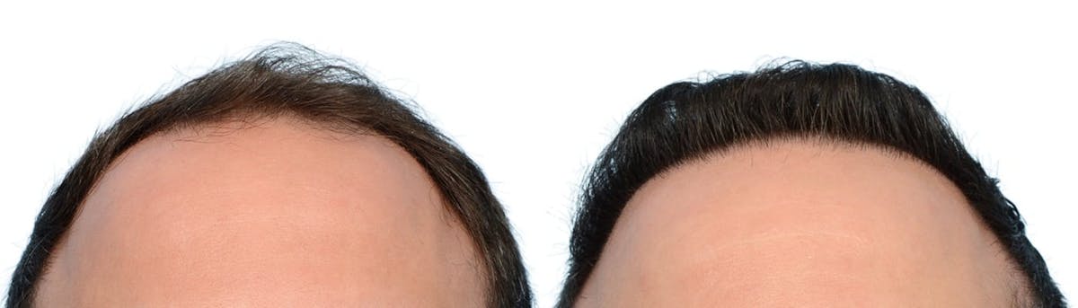 Hair Restoration Before & After Gallery - Patient 427118 - Image 2