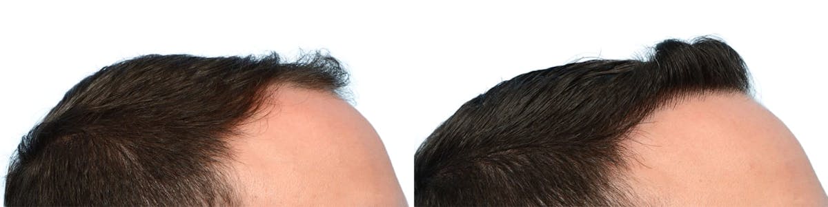 FUE Hair Transplant Before & After Gallery - Patient 189730 - Image 3